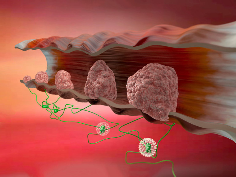 Her gün 100, yılda 35 bin gence teşhis konuyor… Kolon kanserinin 50 yaş altında daha yaygın hale gelmesinin beş nedeni