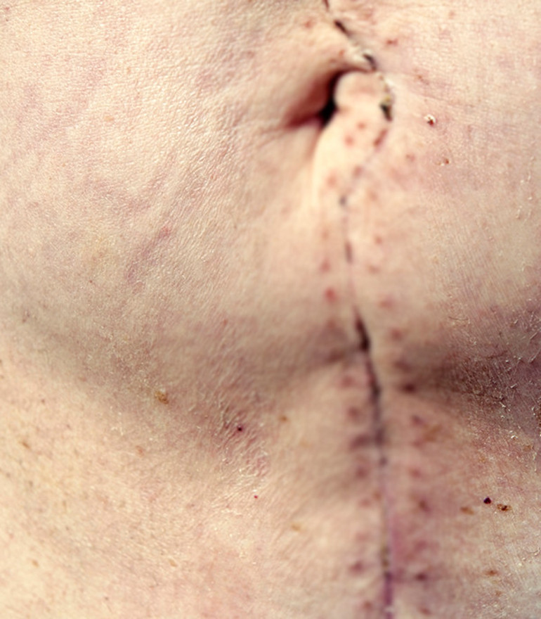 Birkaç gün önce Covid’e yakalandığını öğrenmişti… Doktorlar ‘ilk kez görüyoruz’ dedi…  Geçmeyen öksürük krizinin ardından bağırsakları dışarı fırladı