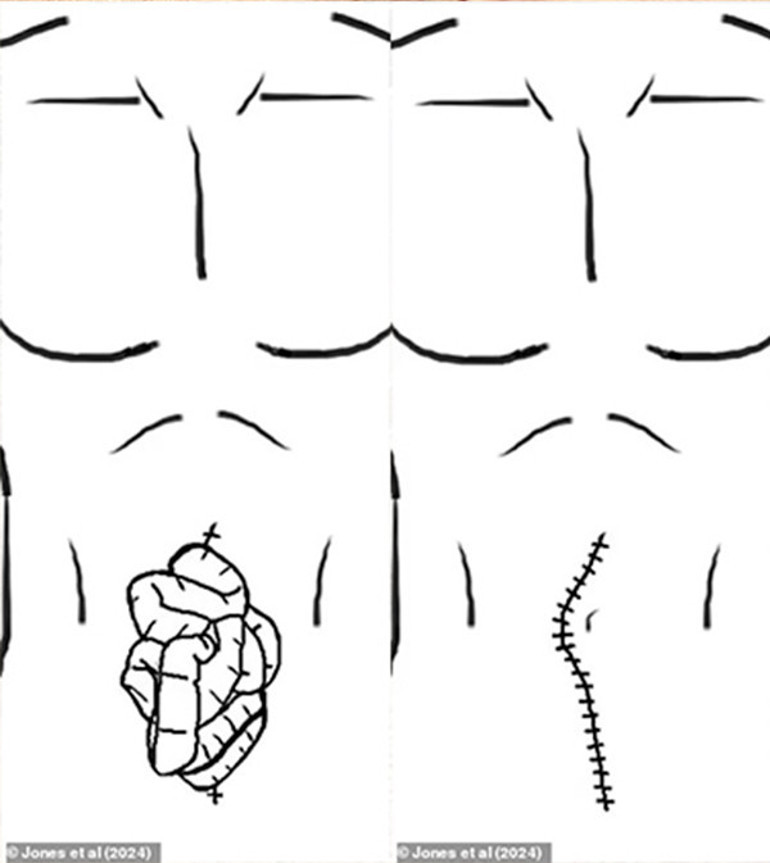 Birkaç gün önce Covid’e yakalandığını öğrenmişti… Doktorlar ‘ilk kez görüyoruz’ dedi…  Geçmeyen öksürük krizinin ardından bağırsakları dışarı fırladı