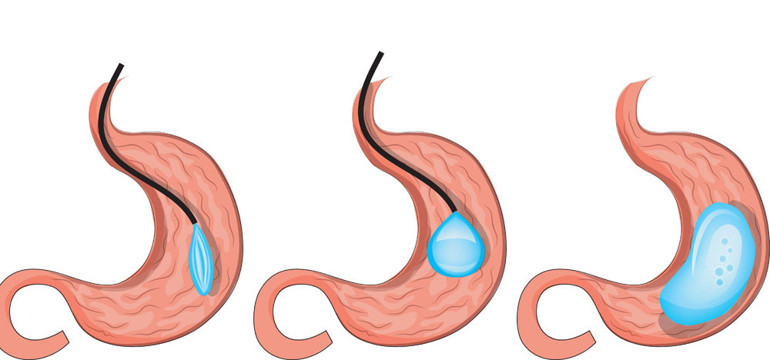 5 SORUDA MİDE BALONU OPERASYONU | 22 yaşındaki genç işlem sırasında hayatını kaybetmişti. Nadir durumlarda ölüm riski taşıyabilir