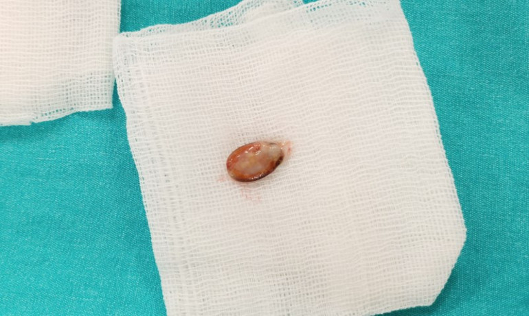 Anne babalar dikkat 3 yıl boyunca şikayeti geçmeyen çocuğun nefes borusundan çıktı, doktorlar şaşkına döndü