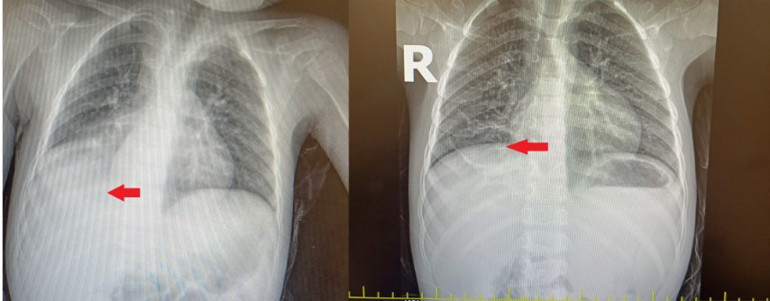 Anne babalar dikkat 3 yıl boyunca şikayeti geçmeyen çocuğun nefes borusundan çıktı, doktorlar şaşkına döndü