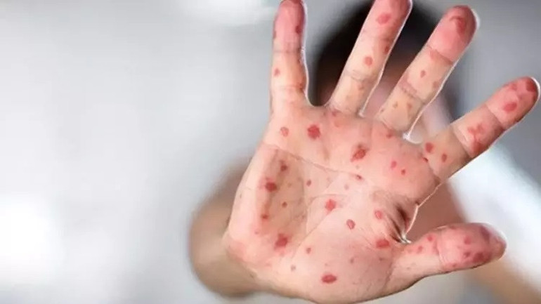 Arka arkaya kırmızı alarm verilmişti… M çiçeği salgını durdurulamıyor: Tüm kıtada acil durum ilan edildi