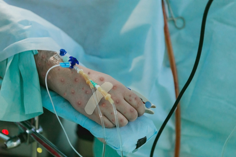 100’den fazla ülkeye yayılmıştı… Koronavirüs dönemi tehlike gözden kaçtı… M çiçeği kabusu geri döndü İki senede iki kez küresel acil durum…