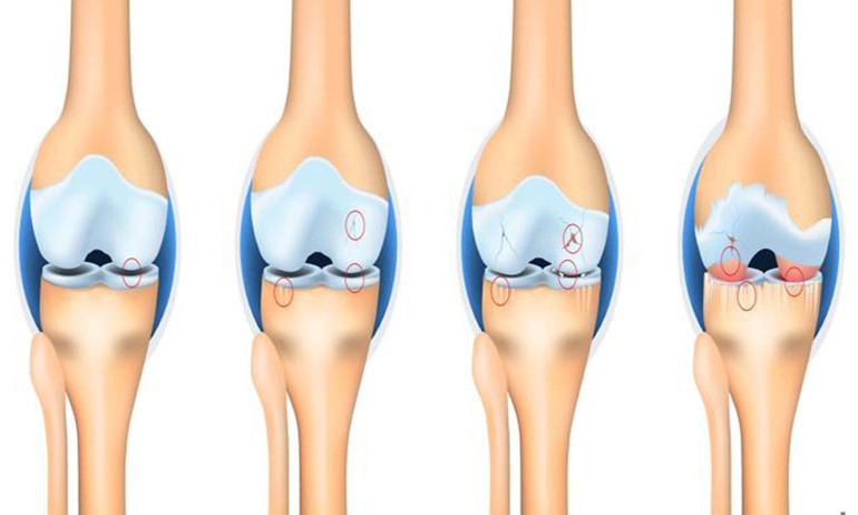 Kuyruk yağı, kantaron yağı, kolajen takviyeleri diz ağrılarına iyi gelir mi