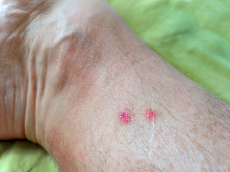 Neden böcekler bazı insanları daha çok ısırır Uzun boylu erkekler daha çok risk altında...