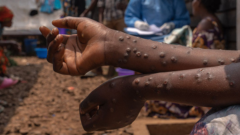 Afrika Birliği uyardı: M çiçeği tüm dünyanın sorunu