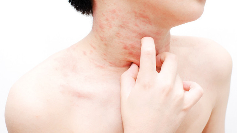 Atopik dermatit sayısı hızla artıyor... Uzun soluklu kronik ama bulaşıcı değil