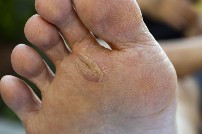 Plantar siğiller: “Her adımda küçük bir kayanın üzerinde yürümek gibi” | Çıplak ayakla dolaşmayın