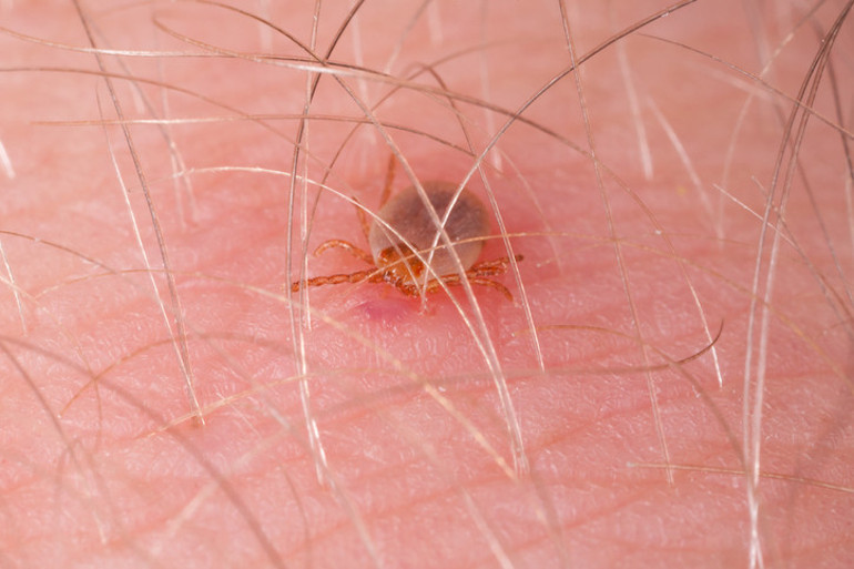 Ünlü komedyen Miranda Hartın hastalığına 30 yıl sonra lyme teşhisi koyuldu | Bir kene tarafından ısırıldığınızı fark etmeyebilirsiniz