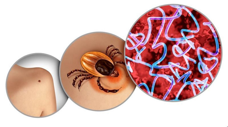 Ünlü komedyen Miranda Hartın hastalığına 30 yıl sonra lyme teşhisi koyuldu | Bir kene tarafından ısırıldığınızı fark etmeyebilirsiniz