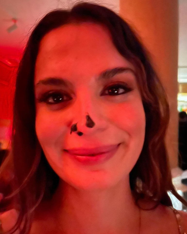 Yasemin Özilhandan estetik açıklaması: Sadece dudak dolgusu