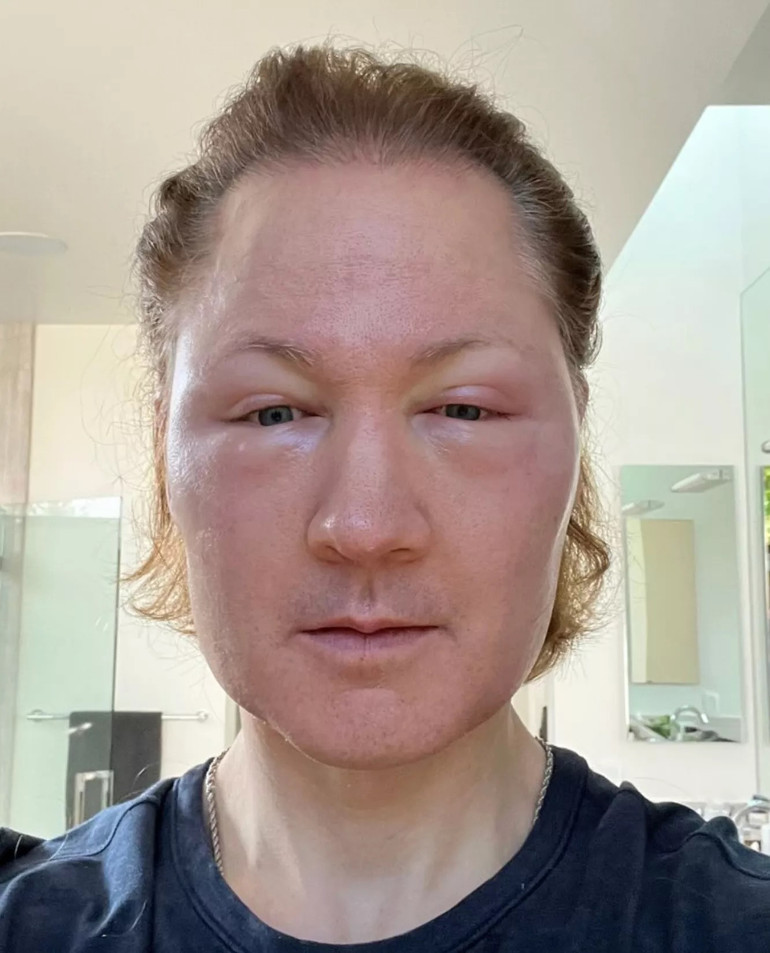 Tüm servetini genç kalmak için harcıyor… ‘Vampir milyoner’ tanınmayacak hale geldi