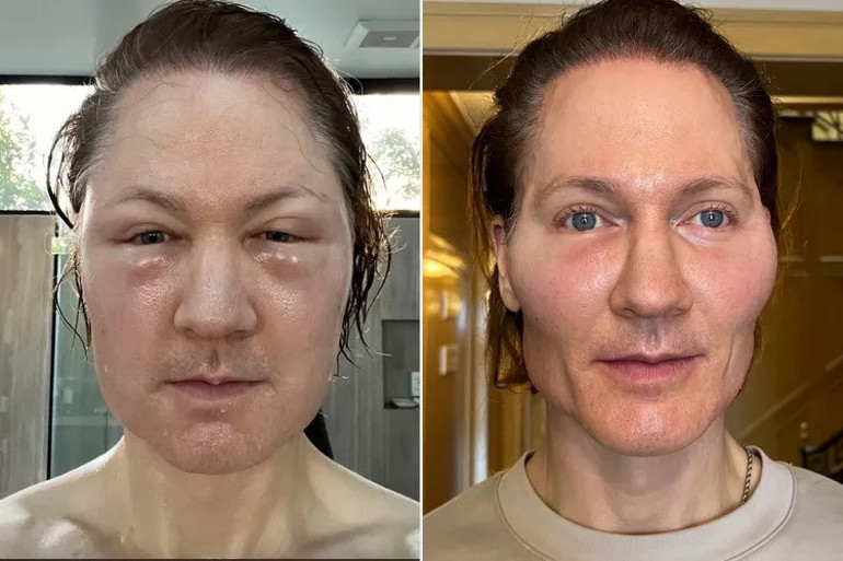 Tüm servetini genç kalmak için harcıyor… ‘Vampir milyoner’ tanınmayacak hale geldi