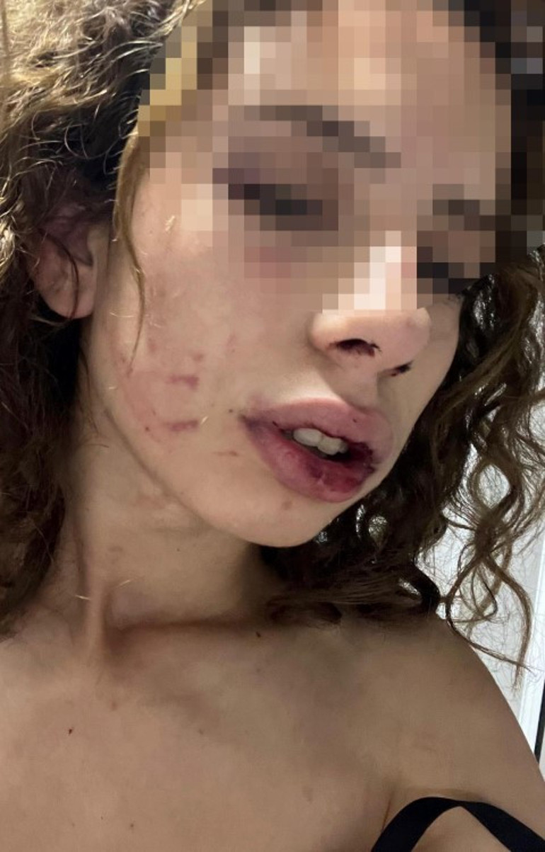 Konyada kız arkadaşına dehşeti yaşatmıştı Sevgiliden yüzsüz savunma: Kendi kendini yaraladı