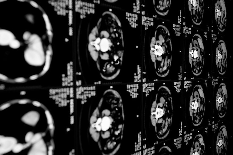 Hastalık vücudunu eritiyor Daha 20’sinde ama 75 yaşında gibi hissediyor… ‘Fiziğim korkunç şekilde değişti, organlarım her an patlayabilir’