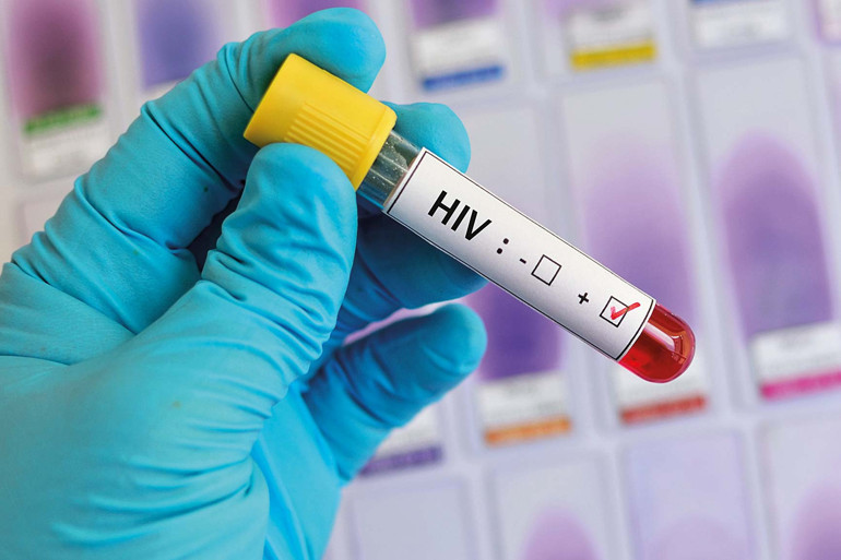 HIV artıyor neden saklıyoruz