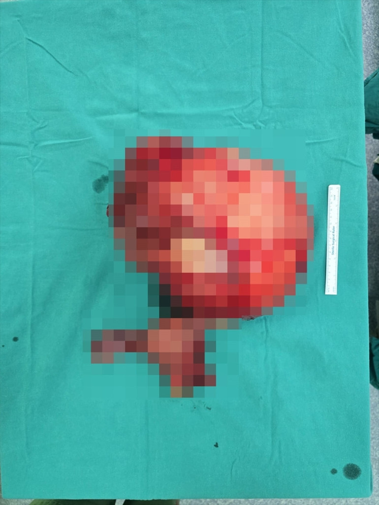 Karın ağrısıyla gittiği hastanede hayatının şokunu yaşadı Karnından 6 kilo büyüklüğünde kitle çıktı