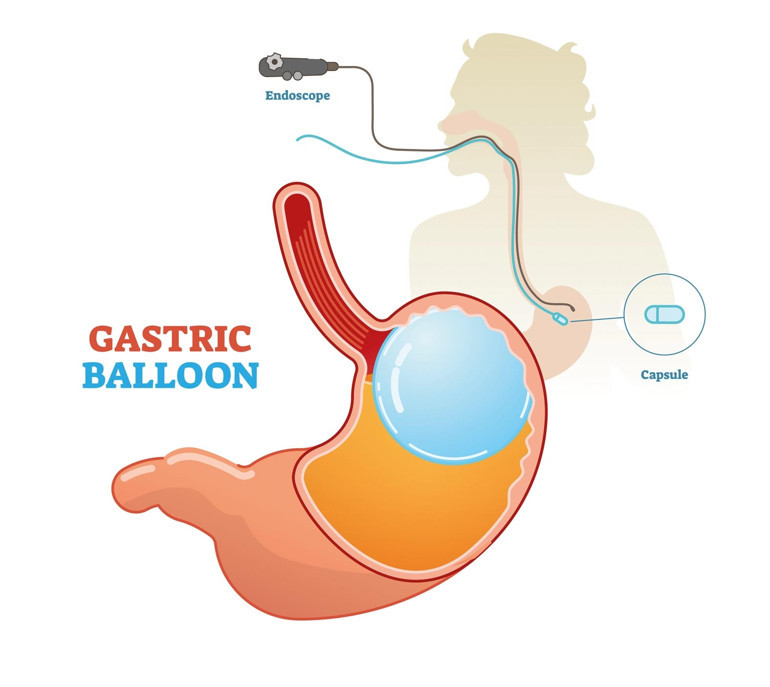 Mide balonu artık yasak