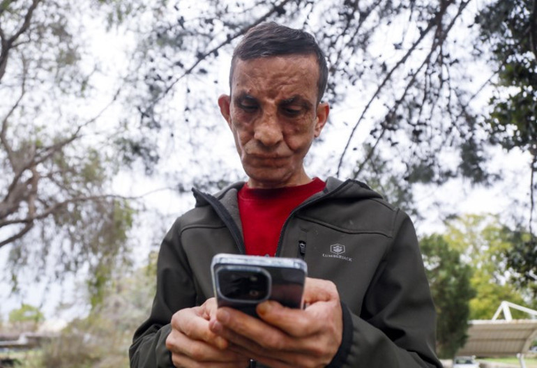 Türkiyenin ilk yüz nakli ona yapılmıştı... Donörün kızı ile duygulandıran görüşme: Babamın yüzü Uğurda yaşıyor