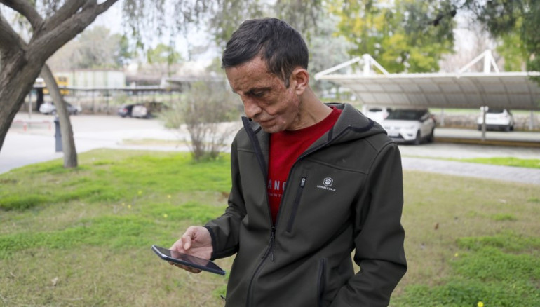 Türkiyenin ilk yüz nakli ona yapılmıştı... Donörün kızı ile duygulandıran görüşme: Babamın yüzü Uğurda yaşıyor