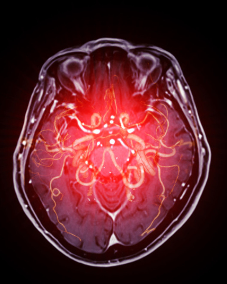 Sadece yaşlıları tehdit etmiyor | Gayet sağlıklı bir sağlık görevlisiydi, 21 yaşında felç geçirdi