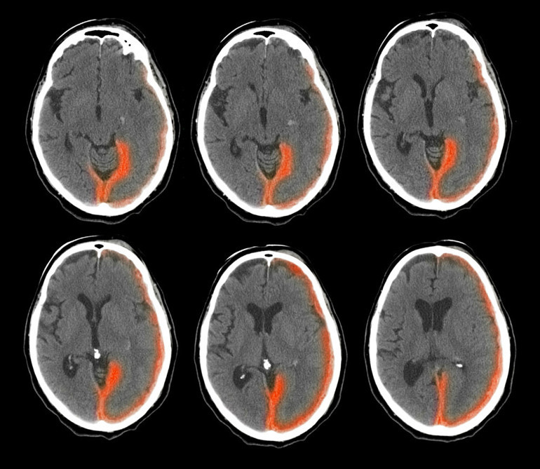Sadece yaşlıları tehdit etmiyor | Gayet sağlıklı bir sağlık görevlisiydi, 21 yaşında felç geçirdi