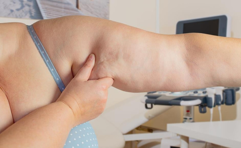 Kadınların baş belası: Lipödem