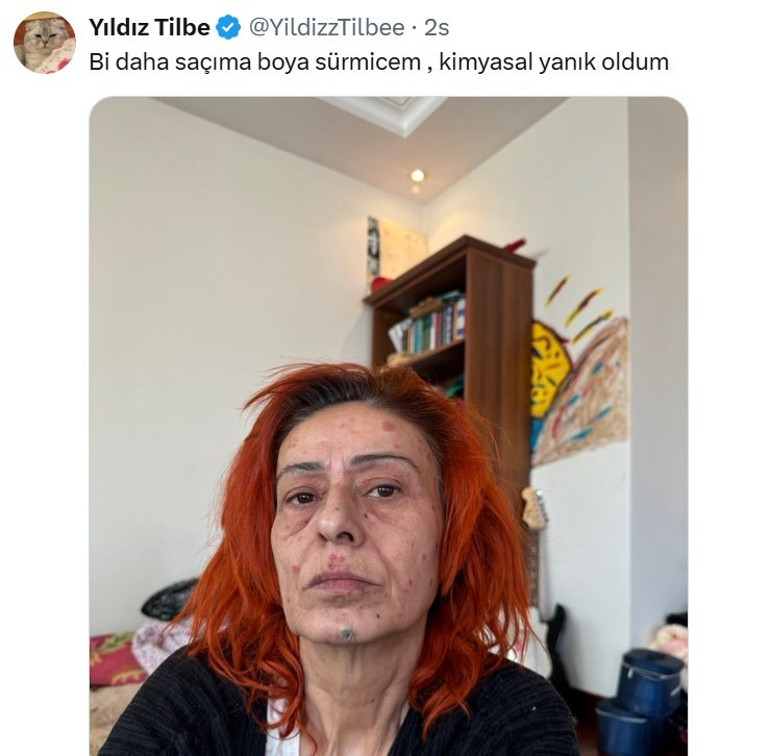 Yıldız Tilbenin yüzünde yanıklar oluştu... Görüntüsü korkuttu