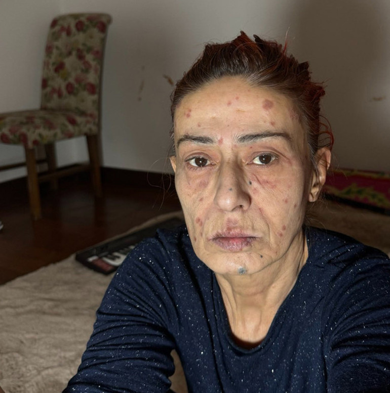 Yıldız Tilbenin yüzünde yanıklar oluştu... Görüntüsü korkuttu