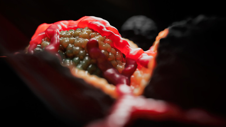 Diyabet sandılar, pankreas kanserinden hayatını kaybetti | Karın ağrısı, hazımsızlık, şişkinlik kanserin habercisi olabilir