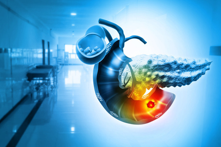 Diyabet sandılar, pankreas kanserinden hayatını kaybetti | Karın ağrısı, hazımsızlık, şişkinlik kanserin habercisi olabilir