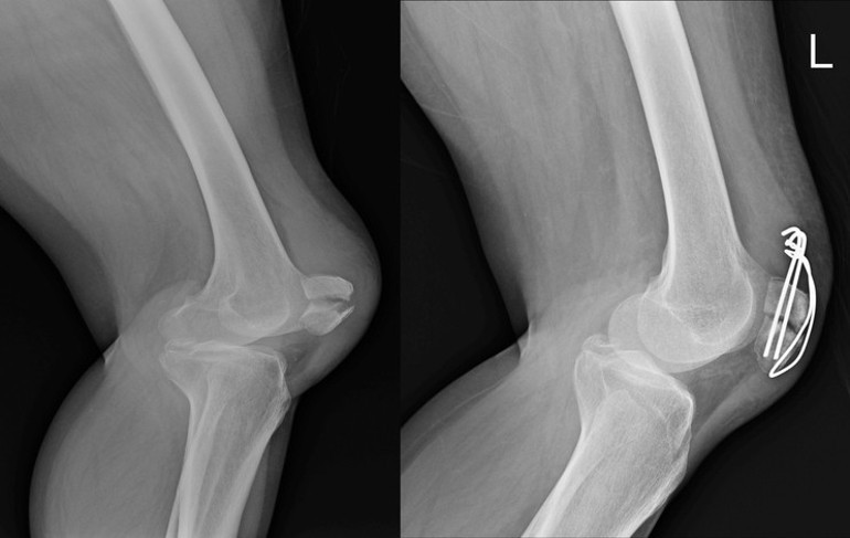 Kırık sandılar ama gerçek MR sonucunda ortaya çıktı Elma kurdunun elmayı yemesi gibi kemiklerin içini boşaltıyor