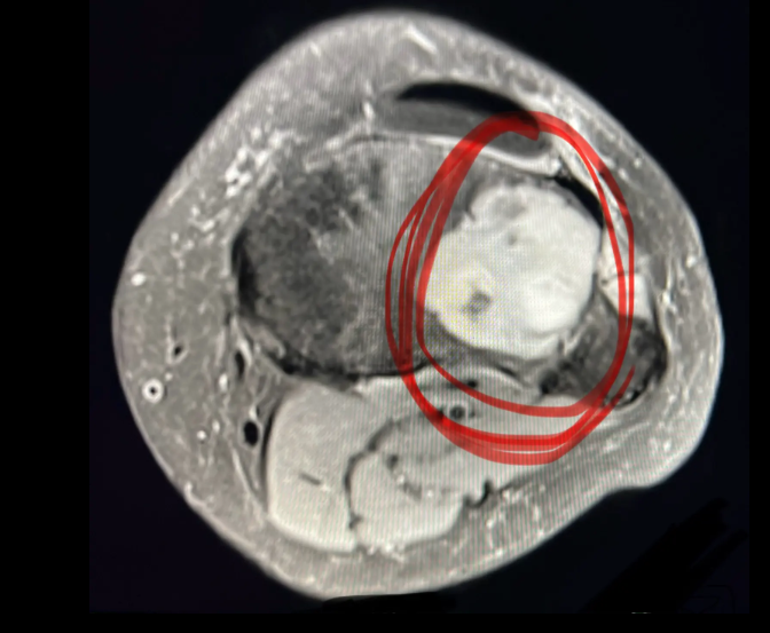 Kırık sandılar ama gerçek MR sonucunda ortaya çıktı Elma kurdunun elmayı yemesi gibi kemiklerin içini boşaltıyor