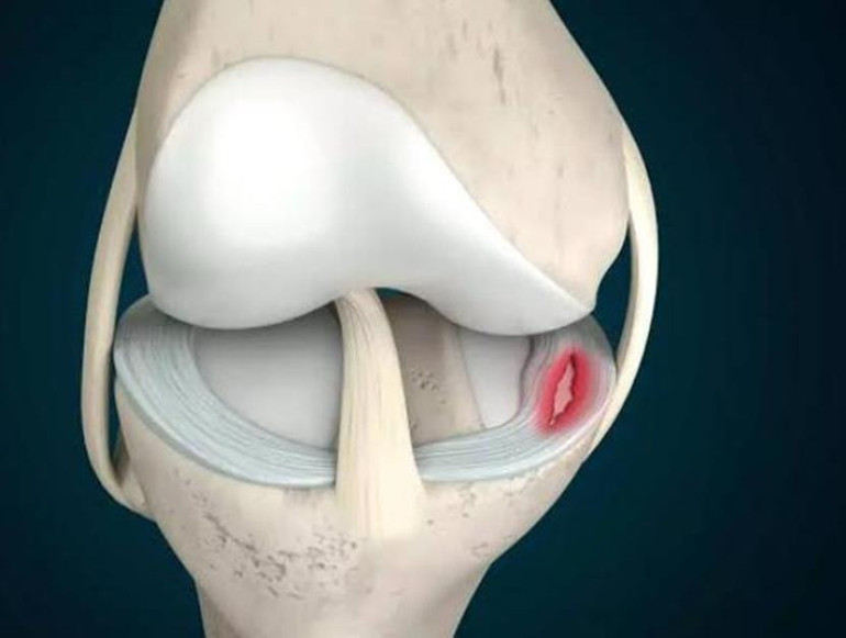 Menisküs yırtıkları ve merak edilenler