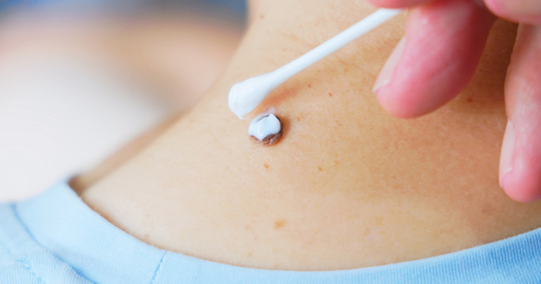 Ünlü komedyenin başına gelenler korkuttu: Kolunda fark etti, hayatının şokunu yaşadı Boyutu ve renkleri ne anlama geliyor