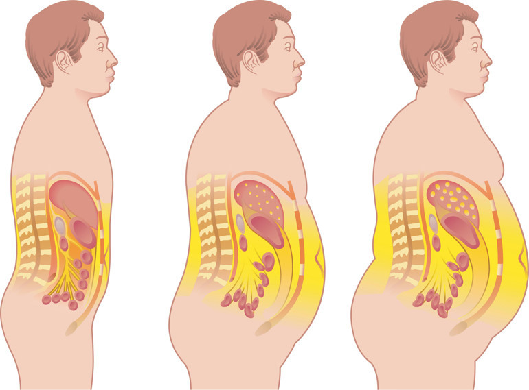 Türkiye son beş yıldır obezitede Avrupa birincisi Sadece yetişkinler değil, çocuklar ve gençler de büyük risk altında… Peki rakamlar neden her geçen gün artıyor