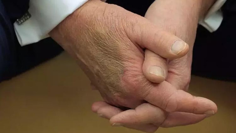 Beyaz Saray açıklama yapmıştı Trumpın elindeki gizemli morluk tekrar ortaya çıktı