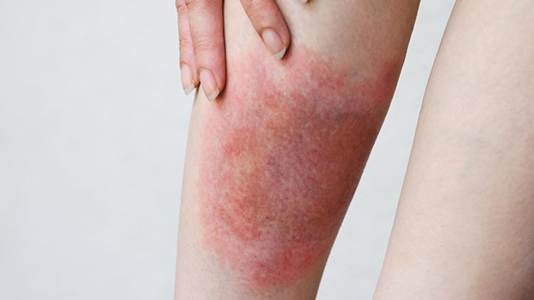 Dünyanın dört bir yanında görülüyor... Lyme hastalığı ‘ABD’nin biyolojik silahı mı