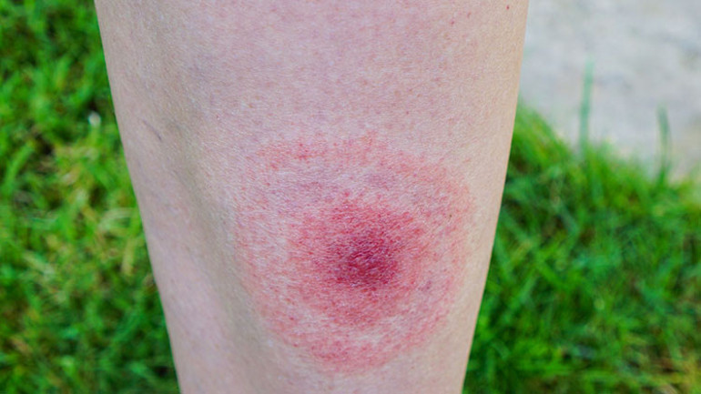 Dünyanın dört bir yanında görülüyor... Lyme hastalığı ‘ABD’nin biyolojik silahı mı