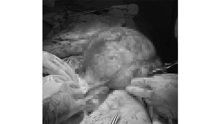 Nadir görülen vaka... Karın ağrısıyla gitti ameliyata alındı Karnından 2 buçuk kiloluk kitle çıktı