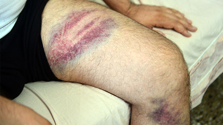 Miras anlaşmazlığı sebebiyle yeğenini darp etti... Kendini böyle savundu: Beni tahrik etti, dayanamadım