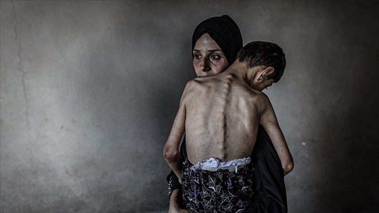 Gazzede 3ü çocuk 5 Filistinli daha açlıktan hayatını kaybetti