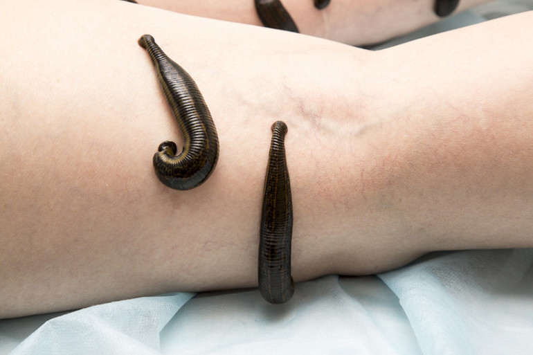 2500 yıllık gelenek can alıyor Enfeksiyon tüm vücudunu sardı, 7 ameliyatla hayata döndü Uzmanlardan kritik 10 uyarı