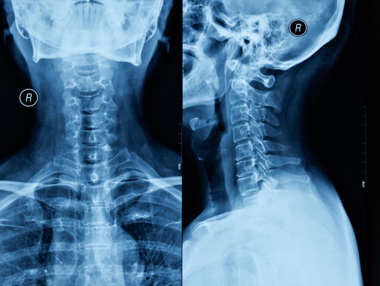 Esnerken boynu kırıldı, ölümün kıyısından döndü ‘Yüzde 50 yaşama şansım vardı’