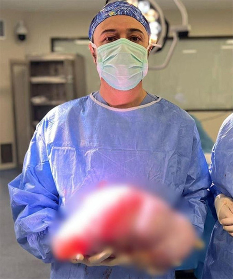 Karnındaki şişliği gaz sandı, hastaneye gitti 5 kiloluk kist çıktı