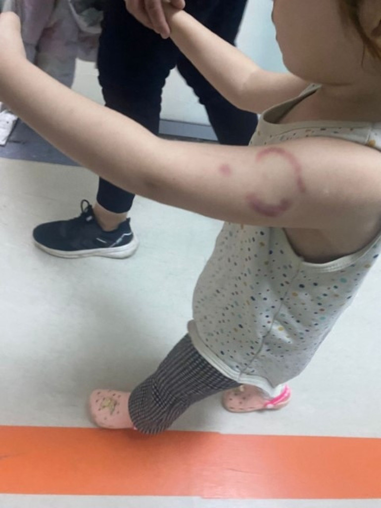 Kreş öğretmeni 3 yaşındaki çocuğun kolunu ısırdı