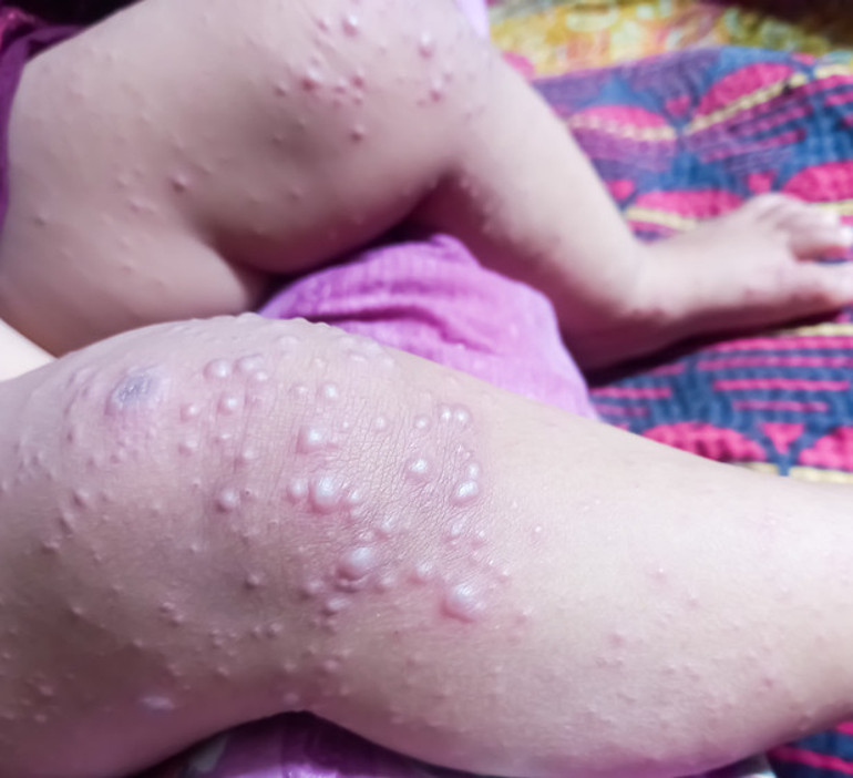 Aşısı yok, antibiyotik işe yaramıyor | Vakalardaki artış normal mi Bazı virüs tipleri menenjit veya kalp kası iltihabına yol açabilir