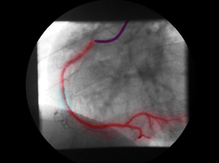 Böbrekleri hasar aldı, ciğerleri su topladı... Muazzez Abacının ölümüne kontrastlı sıvı mı neden oldu | 8 SORU 8 YANIT