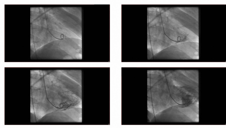 Böbrekleri hasar aldı, ciğerleri su topladı... Muazzez Abacının ölümüne kontrastlı sıvı mı neden oldu | 8 SORU 8 YANIT